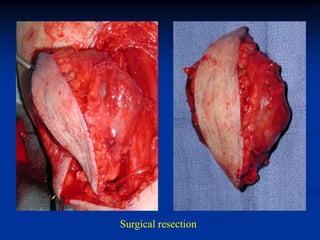 Surgical resection
 