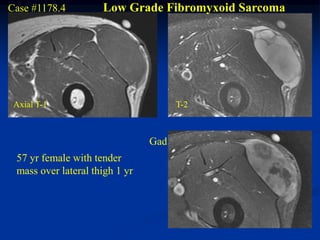 Case #1178.4         Low Grade Fibromyxoid Sarcoma




 Axial T-1                            T-2



                                Gad
 57 yr female with tender
 mass over lateral thigh 1 yr
 