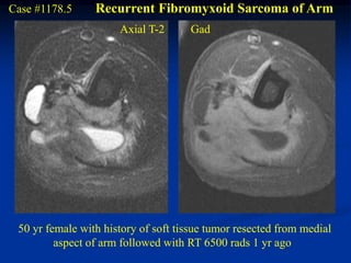 Case #1178.5     Recurrent Fibromyxoid Sarcoma of Arm
                      Axial T-2      Gad




 50 yr female with history of soft tissue tumor resected from medial
         aspect of arm followed with RT 6500 rads 1 yr ago
 
