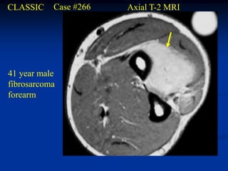 CLASSIC    Case #266   Axial T-2 MRI




41 year male
fibrosarcoma
forearm
 