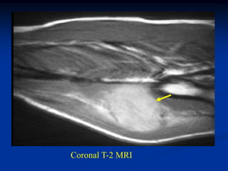 Coronal T-2 MRI
 