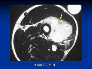 Axial T-2 MRI
 