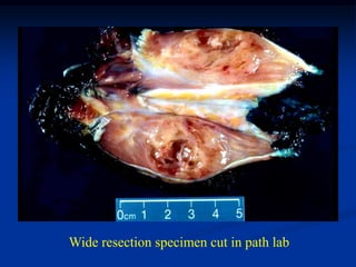 Wide resection specimen cut in path lab
 