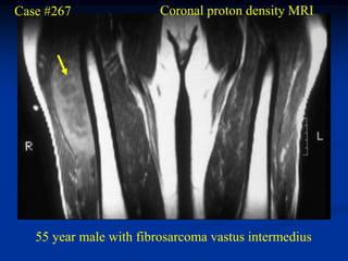 Case #267                Coronal proton density MRI




   55 year male with fibrosarcoma vastus intermedius
 