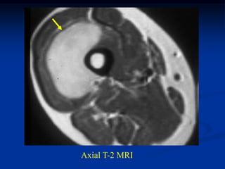 Axial T-2 MRI
 