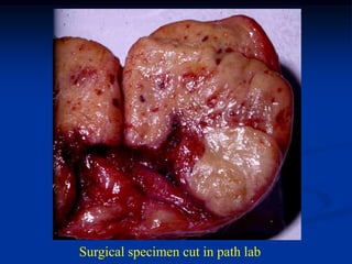Surgical specimen cut in path lab
 