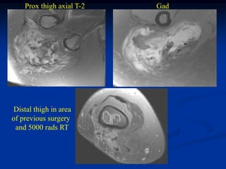 Prox thigh axial T-2   Gad




Distal thigh in area
of previous surgery
 and 5000 rads RT
 
