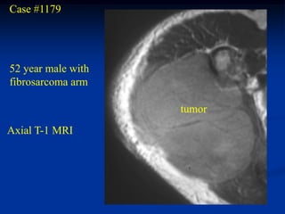 Case #1179




52 year male with
fibrosarcoma arm

                    tumor
Axial T-1 MRI
 