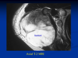 tumor




Axial T-2 MRI
 