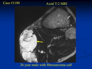 Case #1180                    Axial T-2 MRI




             26 year male with fibrosarcoma calf
 