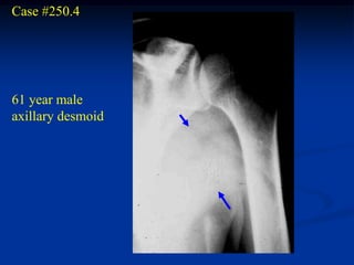 Case #250.4




61 year male
axillary desmoid
 