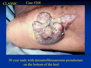 CLASSIC      Case #268




  30 year male with dermatofibrosarcoma protuberans
            on the bottom of the heel
 