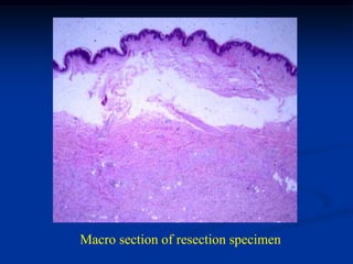 Macro section of resection specimen
 