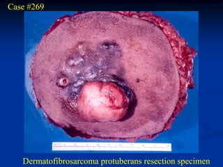 Case #269




   Dermatofibrosarcoma protuberans resection specimen
 