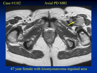 Case #1182               Axial PD MRI




    47 year female with leiomyosarcoma inguinal area
 