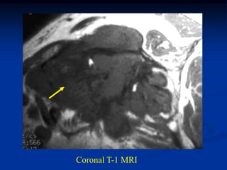 Coronal T-1 MRI
 