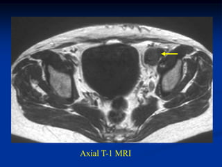 Axial T-1 MRI
 