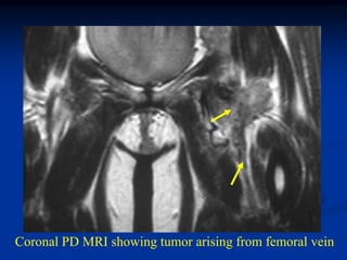 Coronal PD MRI showing tumor arising from femoral vein
 