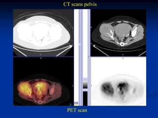 CT scans pelvis




 PET scan
 
