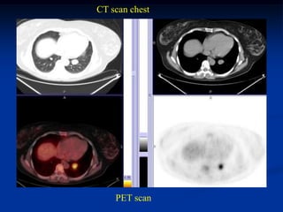 CT scan chest




    PET scan
 