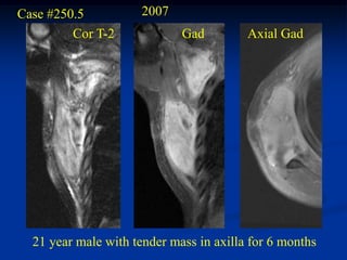 Case #250.5           2007
         Cor T-2             Gad         Axial Gad




  21 year male with tender mass in axilla for 6 months
 