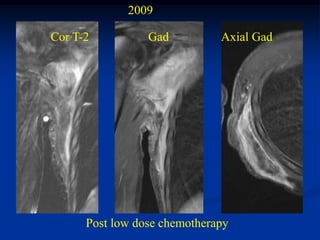 2009

Cor T-2          Gad          Axial Gad




      Post low dose chemotherapy
 