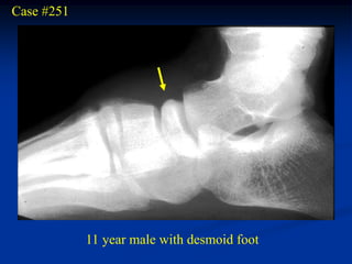 Case #251




            11 year male with desmoid foot
 