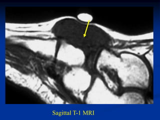 Sagittal T-1 MRI
 