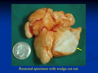 Resected specimen with wedge cut out
 