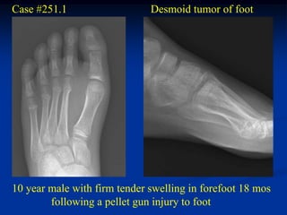 Case #251.1                   Desmoid tumor of foot




10 year male with firm tender swelling in forefoot 18 mos
        following a pellet gun injury to foot
 
