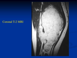 Coronal T-2 MRI
 