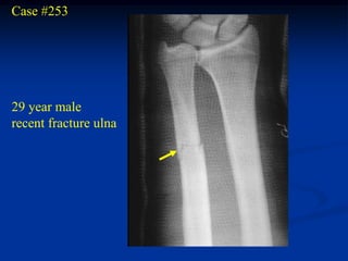Case #253




29 year male
recent fracture ulna
 