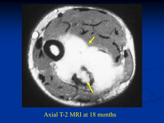 Axial T-2 MRI at 18 months
 