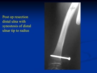 Post op resection
distal ulna with
synostosis of distal
ulnar tip to radius
 