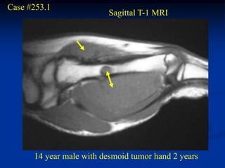 Case #253.1
                          Sagittal T-1 MRI




      14 year male with desmoid tumor hand 2 years
 