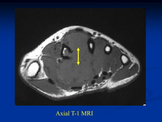 Axial T-1 MRI
 