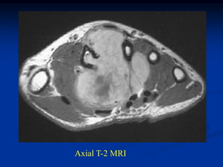 Axial T-2 MRI
 