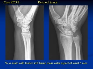 Case #253.2               Desmoid tumor




56 yr male with tender soft tissue mass volar aspect of wrist 6 mos
 