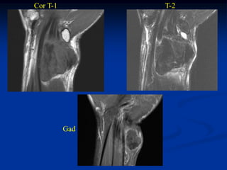 Cor T-1         T-2




          Gad
 