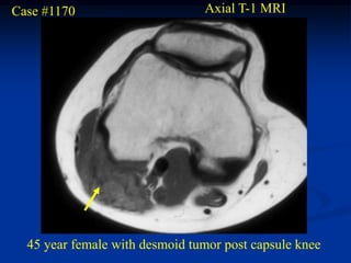 Case #1170                      Axial T-1 MRI




  45 year female with desmoid tumor post capsule knee
 