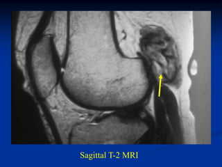 Sagittal T-2 MRI
 