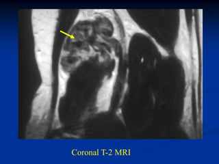 Coronal T-2 MRI
 
