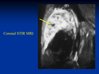 Coronal STIR MRI
 