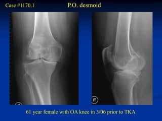 Case #1170.1              P.O. desmoid




        61 year female with OA knee in 3/06 prior to TKA
 