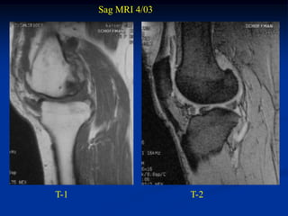 Sag MRI 4/03




T-1                  T-2
 