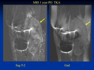MRI 1 year PO TKA




Sag T-2                       Gad
 