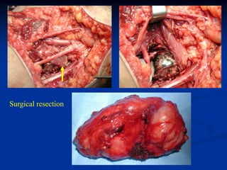 Surgical resection
 