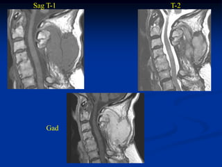 Sag T-1   T-2




   Gad
 