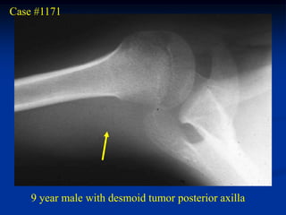 Case #1171




    9 year male with desmoid tumor posterior axilla
 