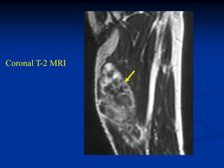 Coronal T-2 MRI
 
